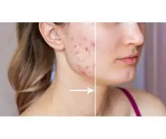 Acne Problems? Try Safe & Proven Scar Removal Treatments
