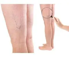 Vein Health Clinic Etobicoke
